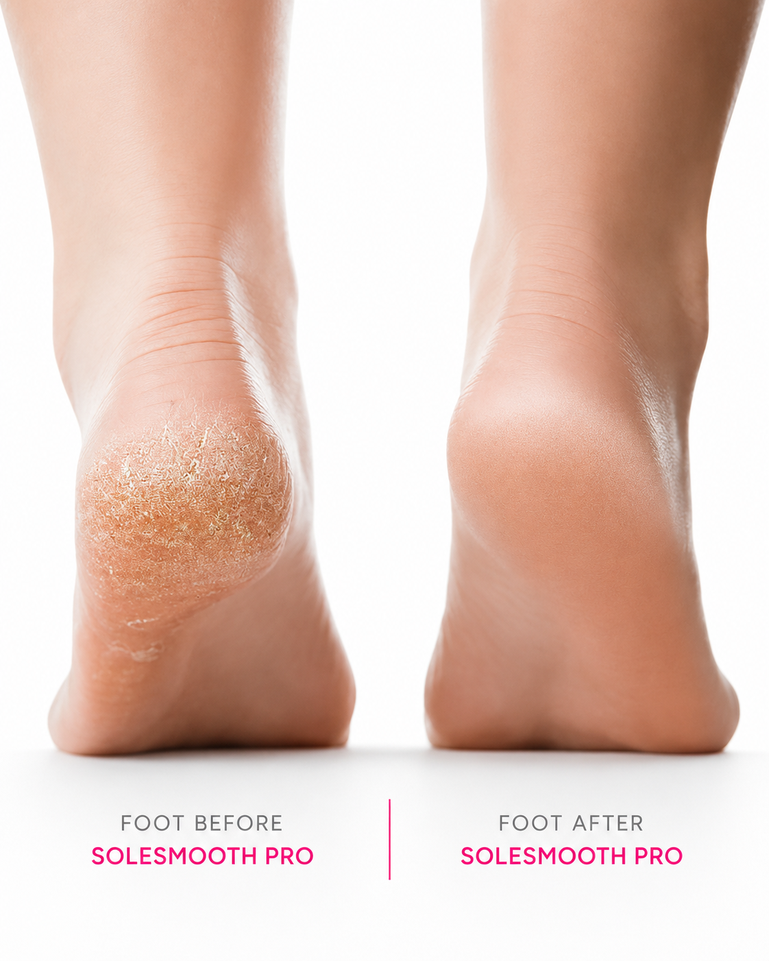 SoleSmooth Pro